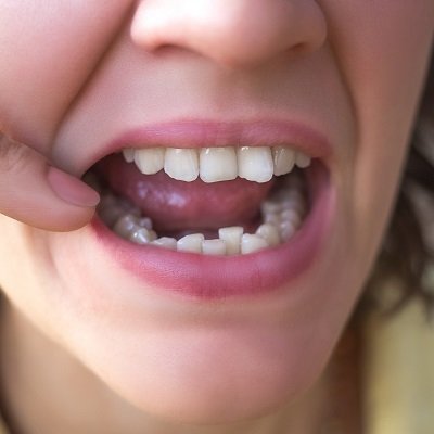 Overlapping Teeth Treatment in Dubai Overlapping Teeth Cost