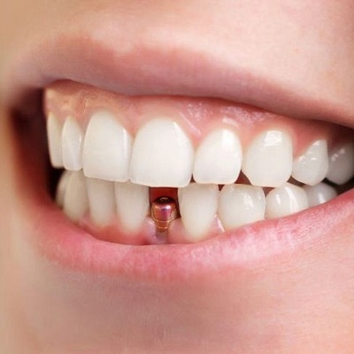 Same Day Dental Implants in Dubai | Single Tooth Dental Implant Cost